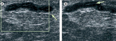 echo doppler testiculaire
