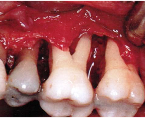 assainissement parodontal par lambeau
