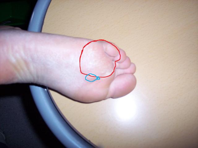 boule de pue sous le pied boule de pue sous le pied