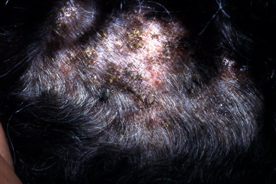 Le shampooing du psoriasis par les mains