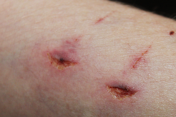 Les parasites dans lorganisme sur la peau