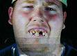 dents pourrix
